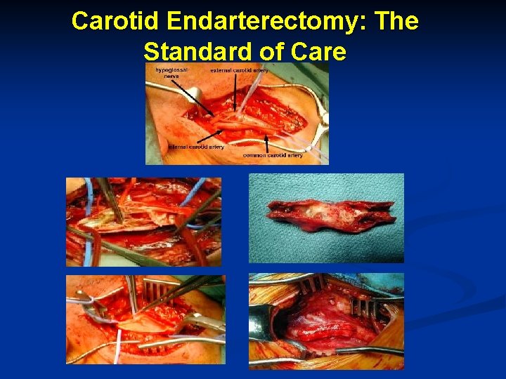 Carotid Endarterectomy: The Standard of Care 