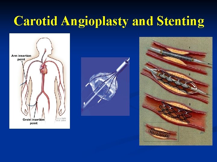 Carotid Angioplasty and Stenting 