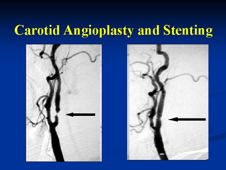 Carotid Angioplasty and Stenting 