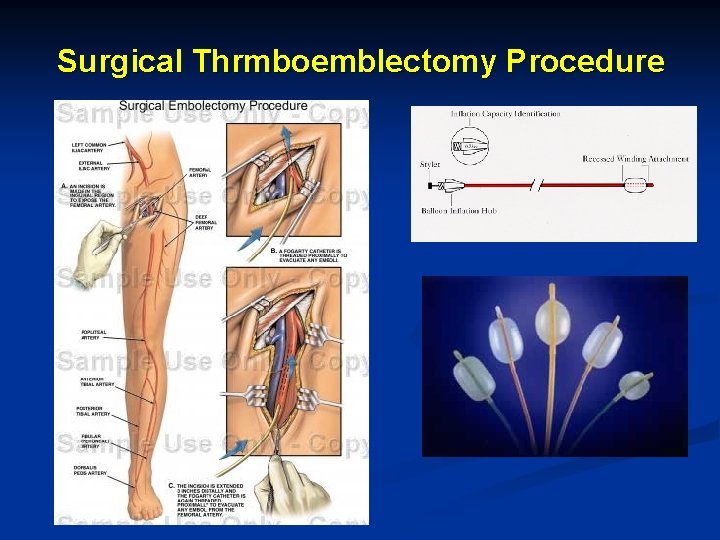 Surgical Thrmboemblectomy Procedure 