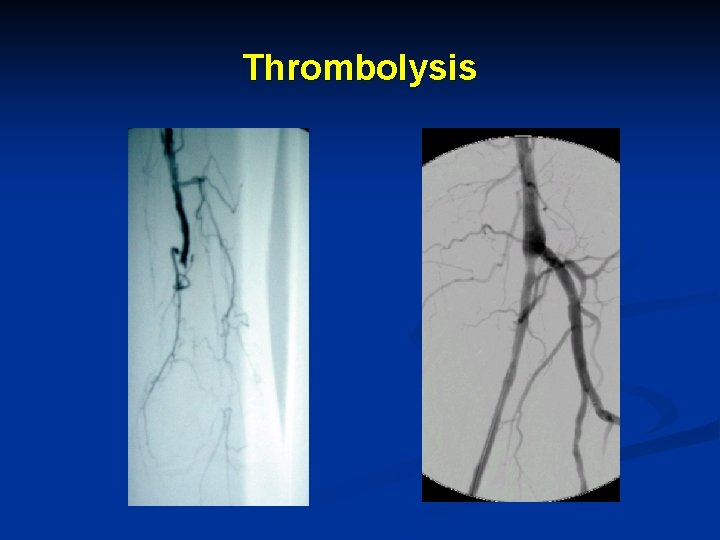 Thrombolysis 