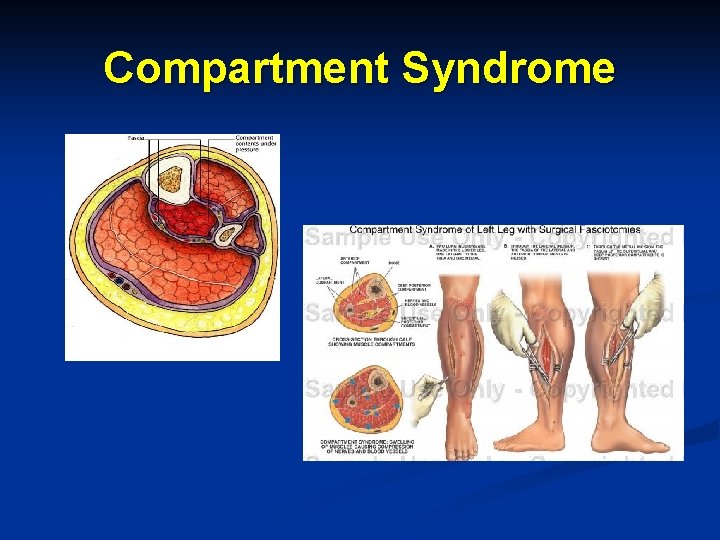 Compartment Syndrome 