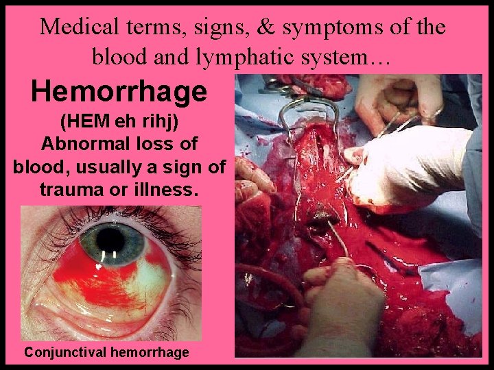 Medical terms, signs, & symptoms of the blood and lymphatic system… Hemorrhage (HEM eh