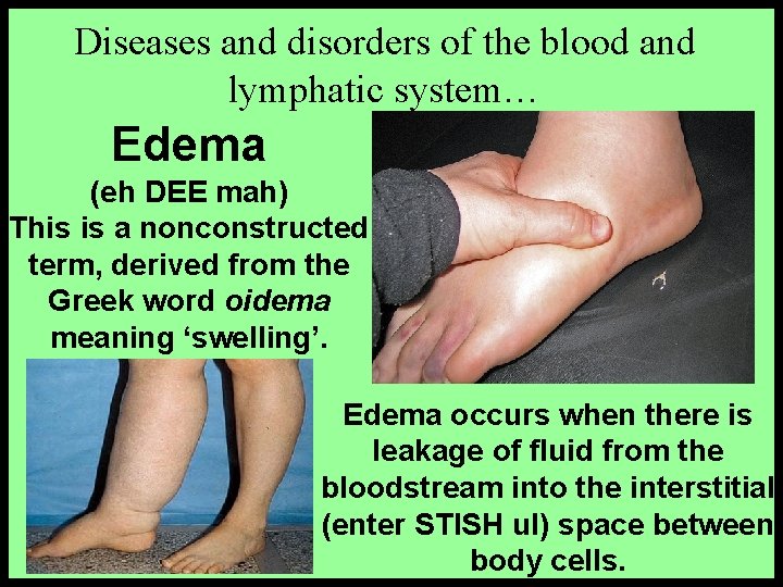Diseases and disorders of the blood and lymphatic system… Edema (eh DEE mah) This