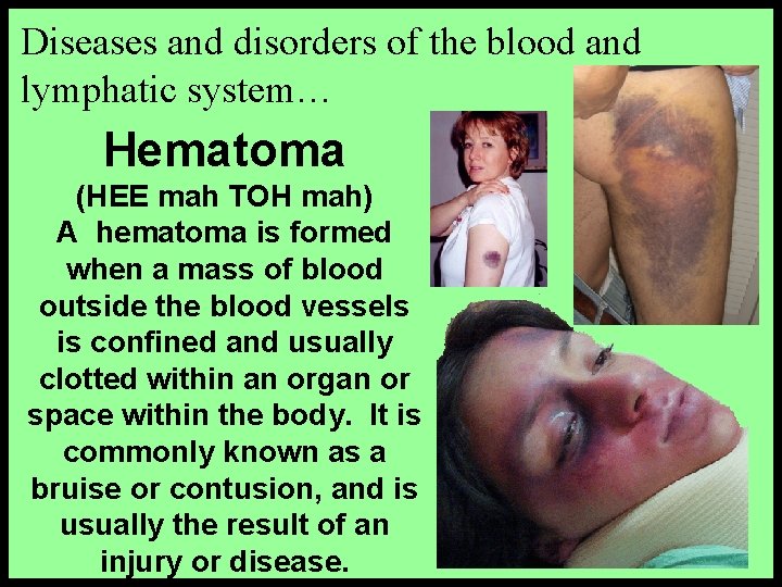 Diseases and disorders of the blood and lymphatic system… Hematoma (HEE mah TOH mah)
