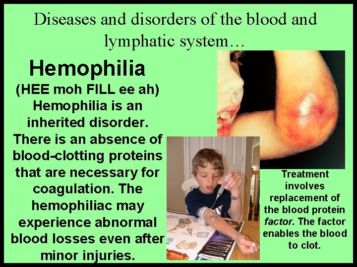 Diseases and disorders of the blood and lymphatic system… Hemophilia (HEE moh FILL ee