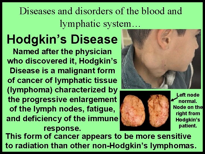 Diseases and disorders of the blood and lymphatic system… Hodgkin’s Disease Named after the
