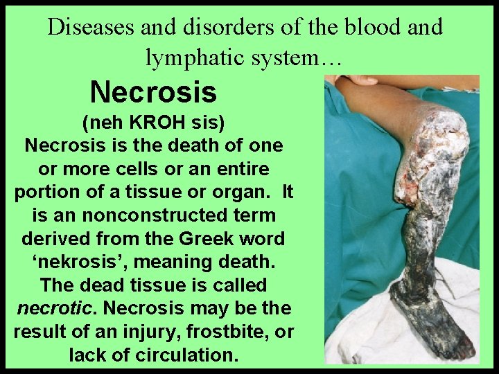 Diseases and disorders of the blood and lymphatic system… Necrosis (neh KROH sis) Necrosis