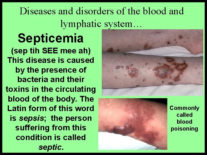 Diseases and disorders of the blood and lymphatic system… Septicemia (sep tih SEE mee
