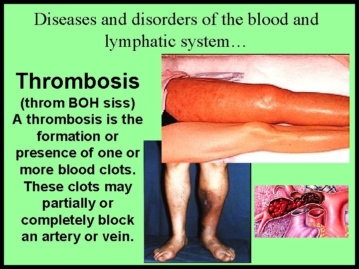 Diseases and disorders of the blood and lymphatic system… Thrombosis (throm BOH siss) A