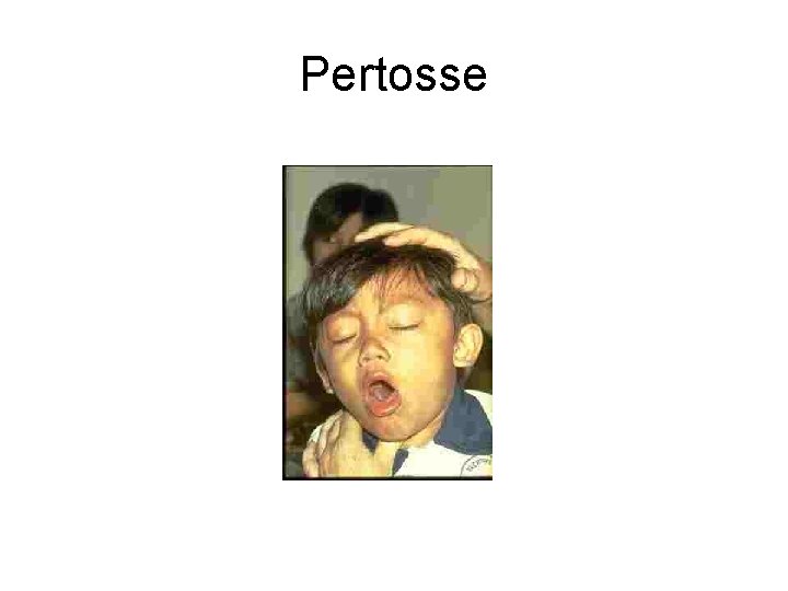 Pertosse 