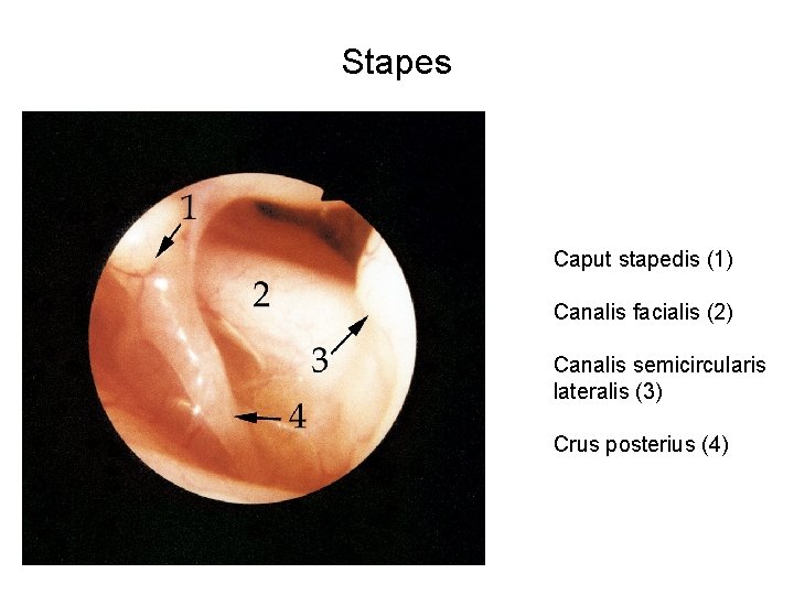 Stapes Caput stapedis (1) Canalis facialis (2) Canalis semicircularis lateralis (3) Crus posterius (4)
