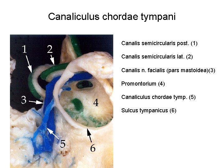 Canaliculus chordae tympani Canalis semicircularis post. (1) Canalis semicircularis lat. (2) Canalis n. facialis