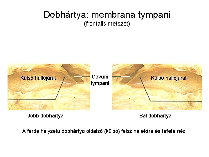 Dobhártya: membrana tympani (frontalis metszet) Külső hallójárat Jobb dobhártya Cavum tympani Külső hallójárat Bal