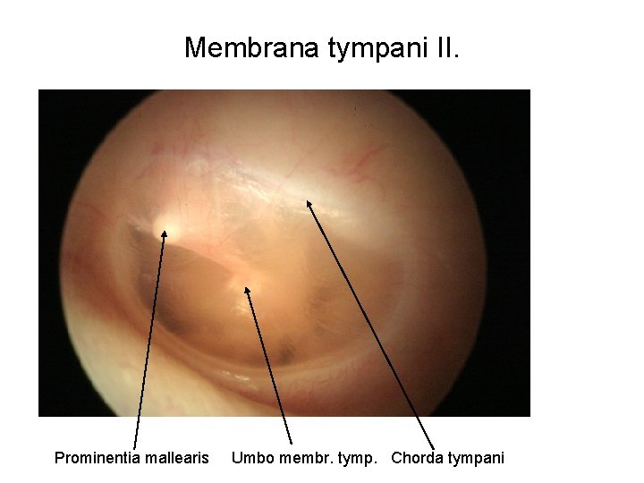 Membrana tympani II. Prominentia mallearis Umbo membr. tymp. Chorda tympani 