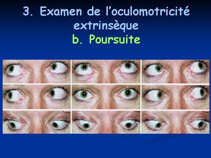 3. Examen de l’oculomotricité extrinsèque b. Poursuite 3. Examen de l’oculomotricité extrinsèque b. Poursuite