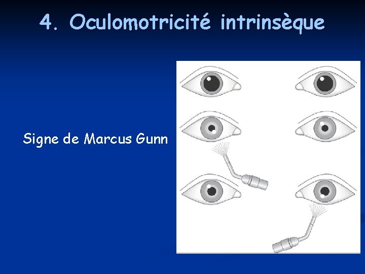 4. Oculomotricité intrinsèque Signe de Marcus Gunn 4. Oculomotricité intrinsèque Signe de Marcus Gunn