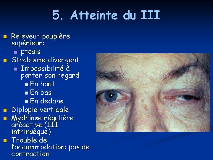 5. Atteinte du III n n n Releveur paupière supérieur: n ptosis Strabisme divergent 5. Atteinte du III n n n Releveur paupière supérieur: n ptosis Strabisme divergent