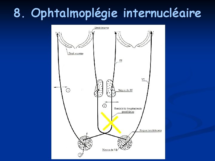 8. Ophtalmoplégie internucléaire 8. Ophtalmoplégie internucléaire