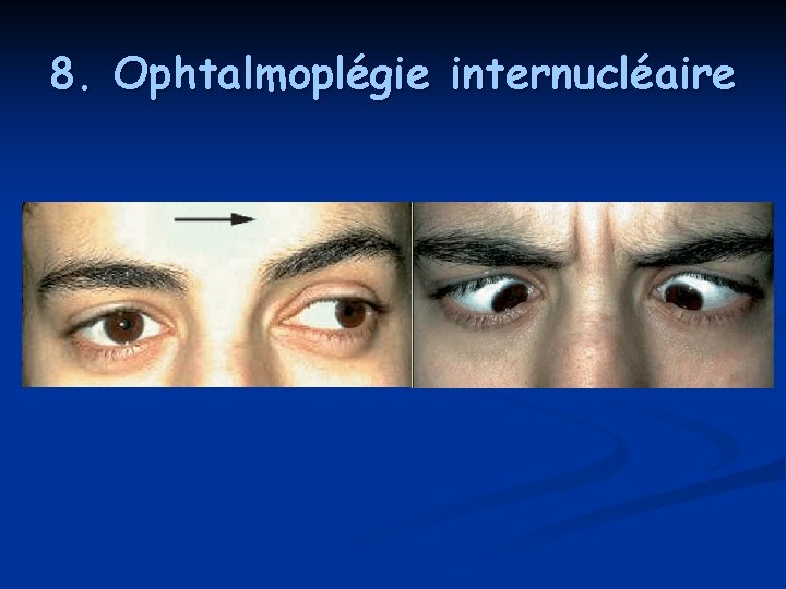 8. Ophtalmoplégie internucléaire 8. Ophtalmoplégie internucléaire