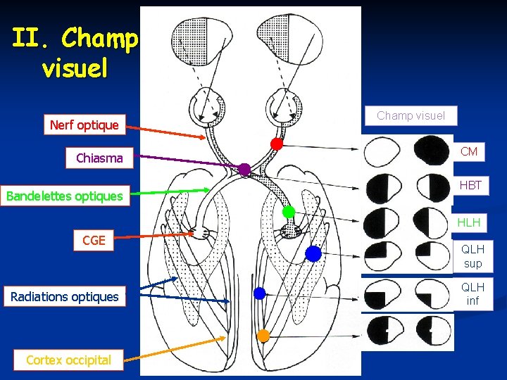 II. Champ visuel Nerf optique Chiasma Bandelettes optiques Champ visuel CM HBT HLH CGE II. Champ visuel Nerf optique Chiasma Bandelettes optiques Champ visuel CM HBT HLH CGE