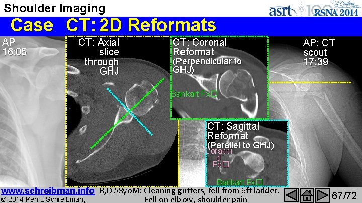 Shoulder Imaging Case CT: 2 D Reformats AP Bones. S C H CT: Axial