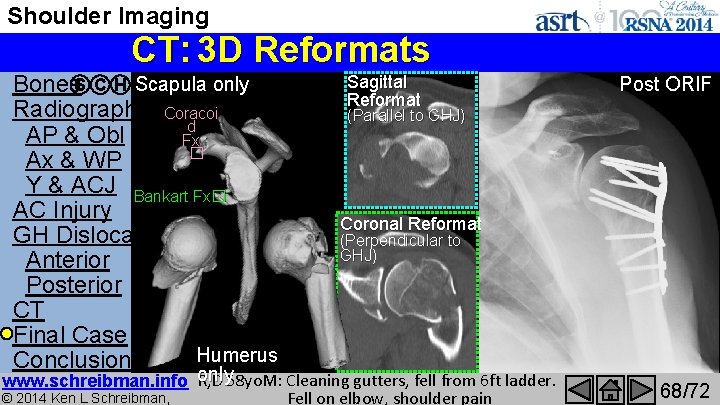 Shoulder Imaging CT: 3 D Reformats Sagittal 36 Images: Ribs Reoriented Removed & Clavicle