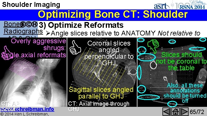 Shoulder Imaging Optimizing Bone CT: Shoulder Bones. S C H 3) Optimize Reformats Radiographs