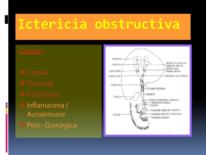Ictericia obstructiva Causas: v Litiasis v Tumoral v Parasitosis v Inflamatoria / Autoinmune v