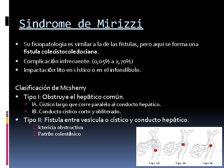 Sindrome de Mirizzi Su fisiopatología es similar a la de las fístulas, pero aquí