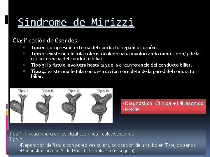 Sindrome de Mirizzi Clasificación de Csendes: Tipo 1: compresión externa del conducto hepático común.