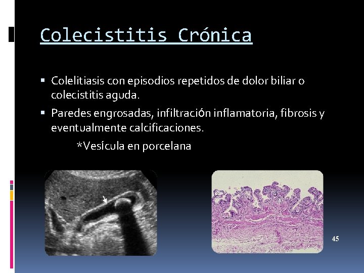Colecistitis Crónica Colelitiasis con episodios repetidos de dolor biliar o colecistitis aguda. Paredes engrosadas,