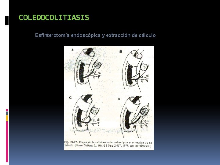 COLEDOCOLITIASIS Esfinterotomía endoscópica y extracción de cálculo 