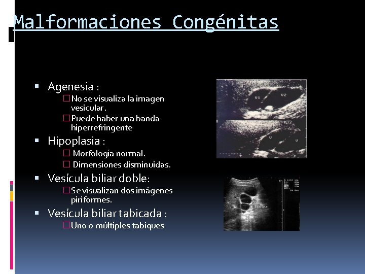 Malformaciones Congénitas Agenesia : �No se visualiza la imagen vesicular. �Puede haber una banda