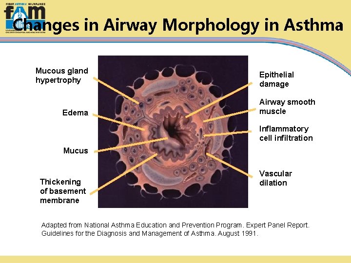Changes in Airway Morphology in Asthma Mucous gland hypertrophy Edema Epithelial damage Airway smooth