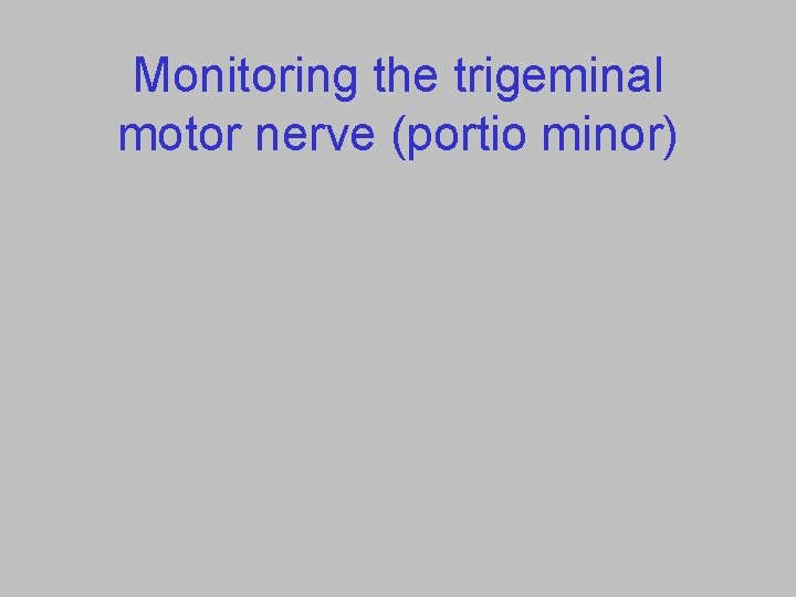 Monitoring the trigeminal motor nerve (portio minor) 