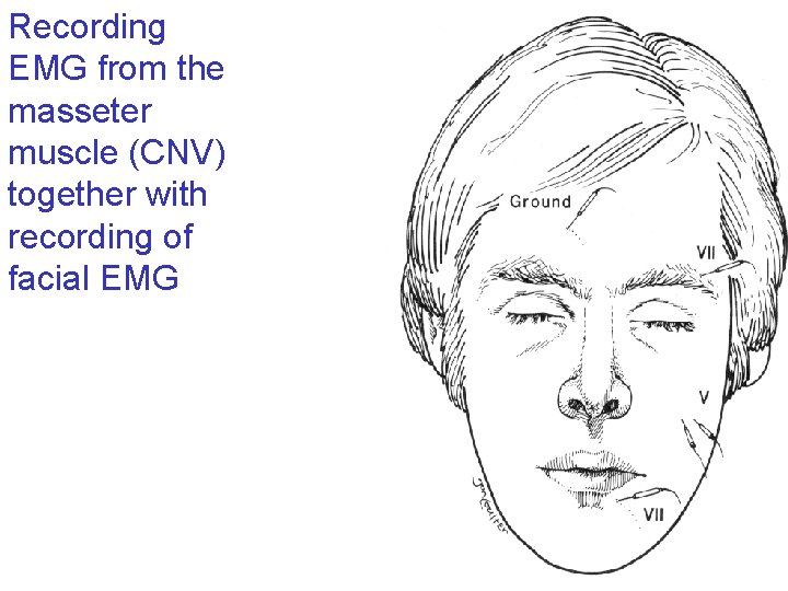 Recording EMG from the masseter muscle (CNV) together with recording of facial EMG 