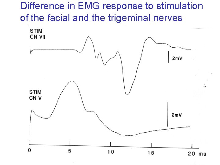 Difference in EMG response to stimulation of the facial and the trigeminal nerves 