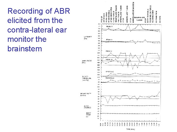 Recording of ABR elicited from the contra-lateral ear monitor the brainstem 