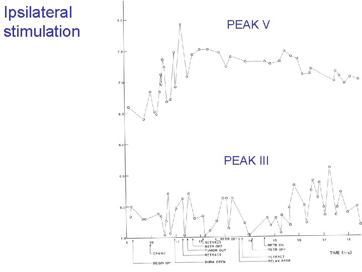 Ipsilateral stimulation Waveform analysis of the BAEP provides information about the anatomical location of