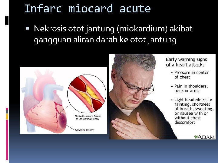 Infarc miocard acute Nekrosis otot jantung (miokardium) akibat gangguan aliran darah ke otot jantung