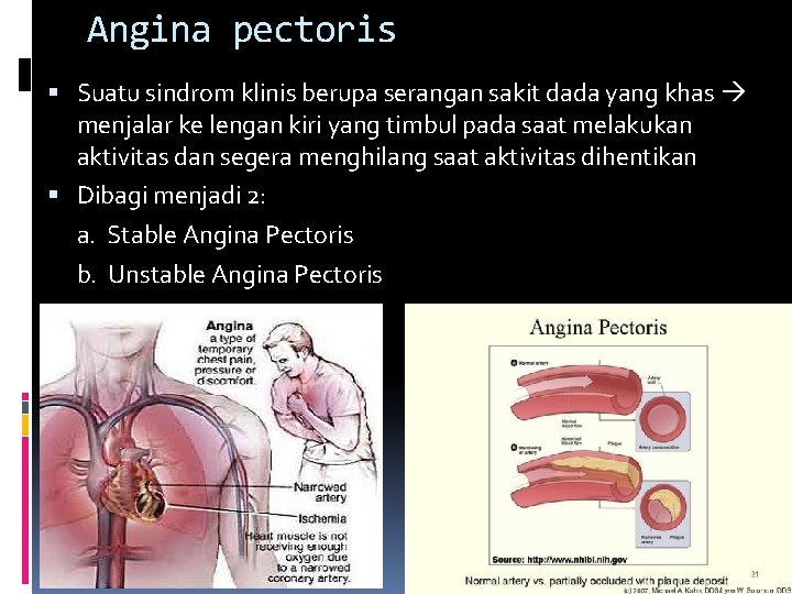 Angina pectoris Suatu sindrom klinis berupa serangan sakit dada yang khas menjalar ke lengan