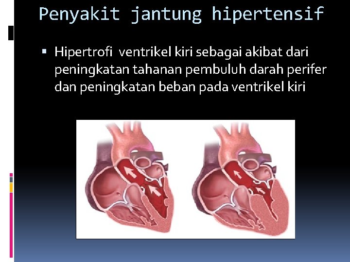 Penyakit jantung hipertensif Hipertrofi ventrikel kiri sebagai akibat dari peningkatan tahanan pembuluh darah perifer