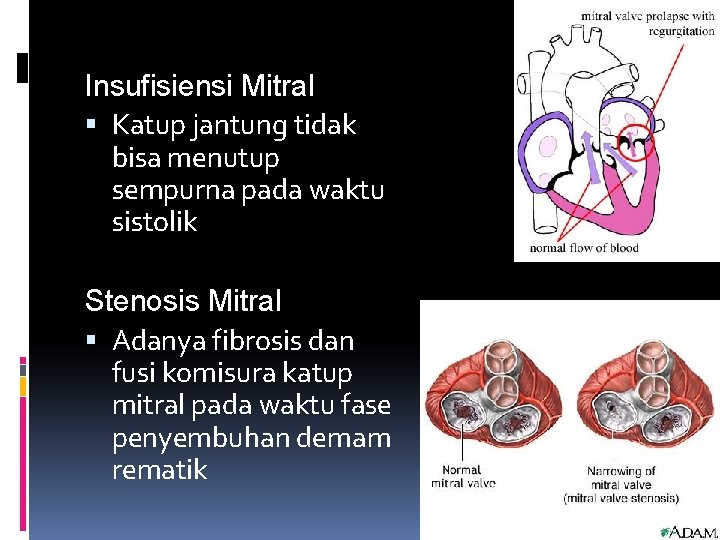 Insufisiensi Mitral Katup jantung tidak bisa menutup sempurna pada waktu sistolik Stenosis Mitral Adanya