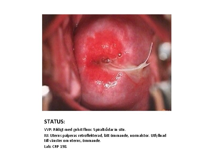 STATUS: VVP: Rikligt med gulvit fluor. Spiraltrådar in situ. IU: Uterus palperas retroflekterad, lätt