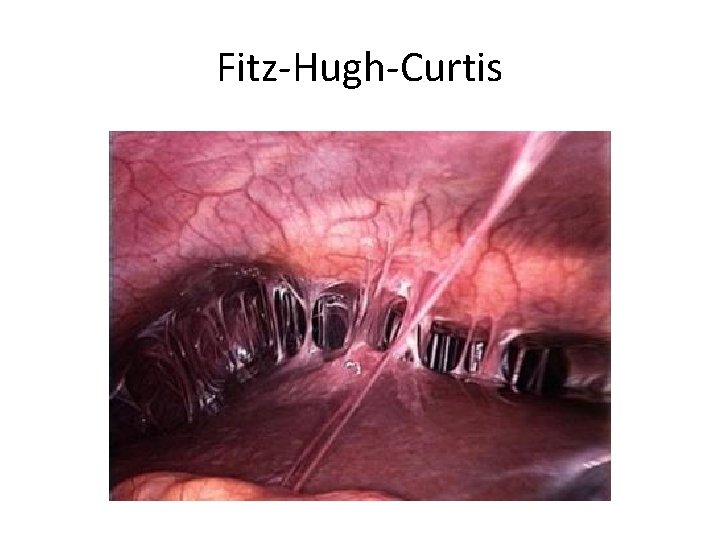 Fitz-Hugh-Curtis 