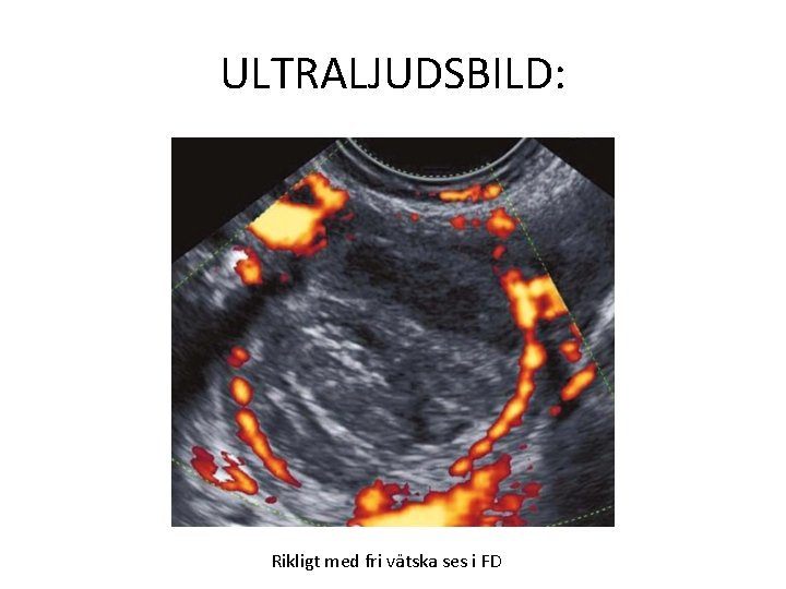 ULTRALJUDSBILD: Rikligt med fri vätska ses i FD 