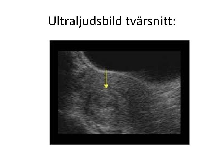 Ultraljudsbild tvärsnitt: 