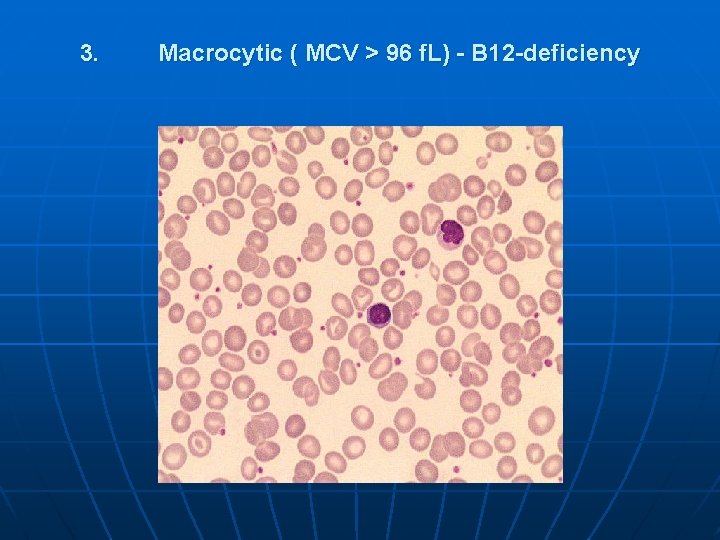 3. Macrocytic ( MCV > 96 f. L) - В 12 -deficiency 