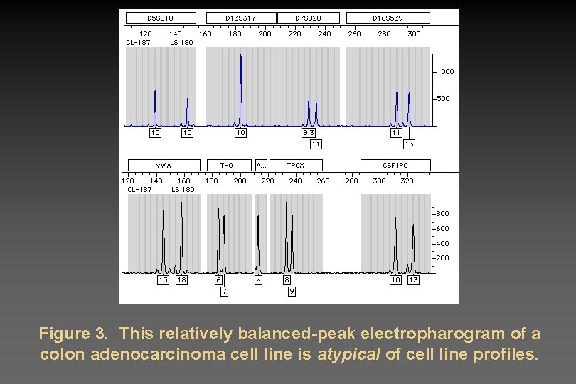 Figure 3. This relatively balanced-peak electropharogram of a colon adenocarcinoma cell line is atypical